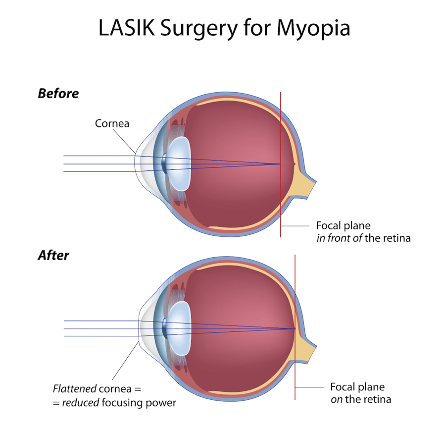 Laser Eye Surgery Brisbane